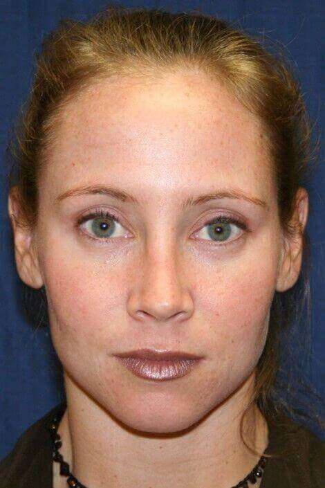 Rhinoplasty Before & After Patient #6132