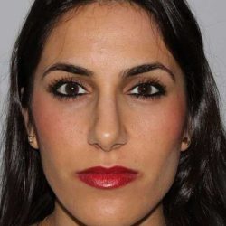 Rhinoplasty Before & After Patient #6139