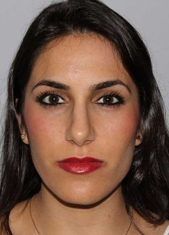 Rhinoplasty Before & After Patient #6139