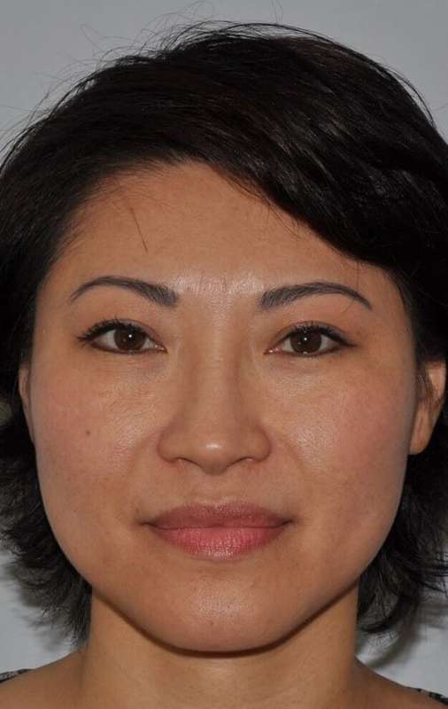 Rhinoplasty Before & After Patient #6146