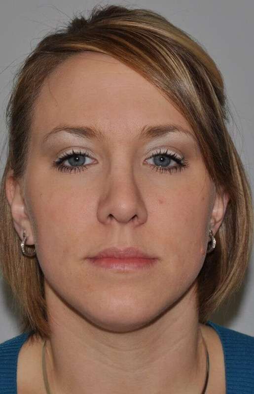 Rhinoplasty Before & After Patient #6153