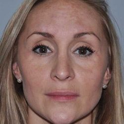 Rhinoplasty Before & After Patient #6160