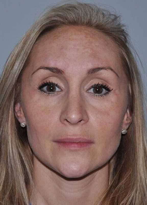 Rhinoplasty Before & After Patient #6160