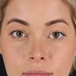 Rhinoplasty Before & After Patient #6178