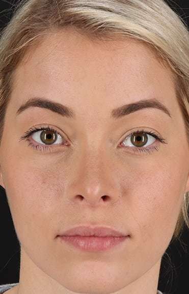Rhinoplasty Before & After Patient #6178