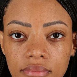 Rhinoplasty Before & After Patient #6189