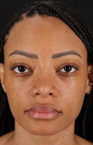 Rhinoplasty Before & After Patient #6189