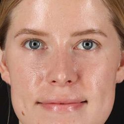 Rhinoplasty Before & After Patient #6200