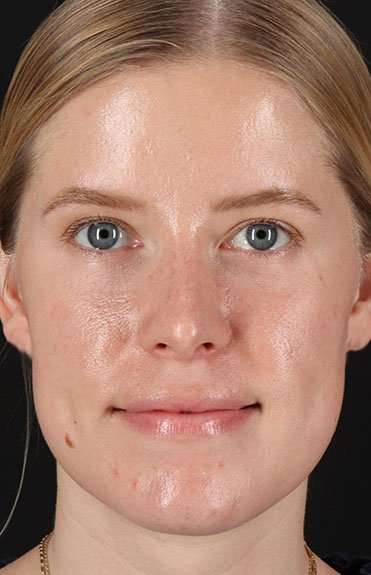 Rhinoplasty Before & After Patient #6200