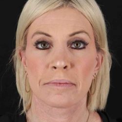 Rhinoplasty Before & After Patient #6211