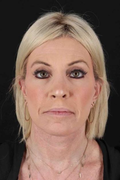 Rhinoplasty Before & After Patient #6211