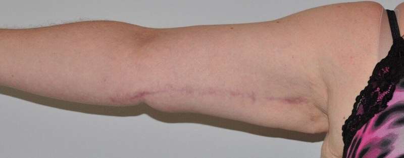 Brachioplasty (Arm Lift) Before & After Patient #1166