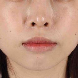 Lip Reduction Before & After Patient #6222