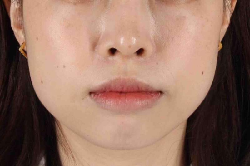 Lip Reduction Before & After Patient #6222