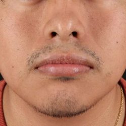 Lip Reduction Before & After Patient #6233