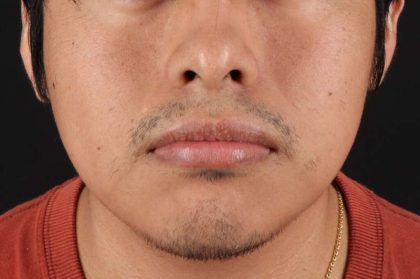 Lip Reduction Before & After Patient #6233