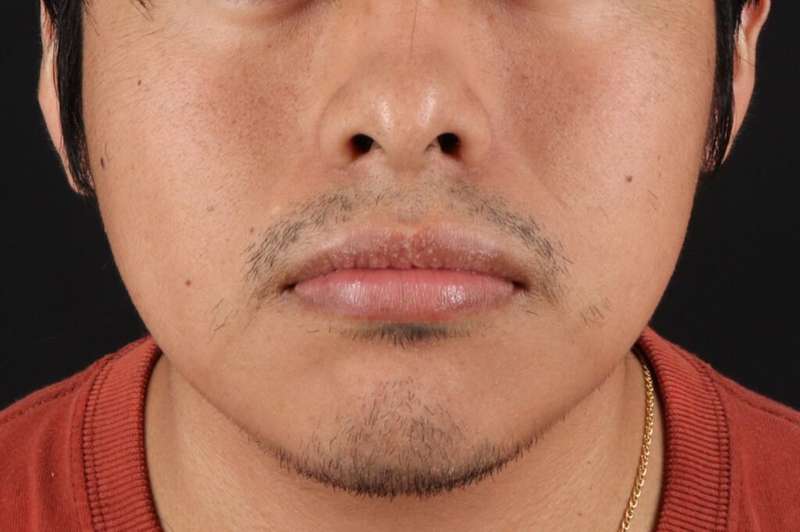 Lip Reduction Before & After Patient #6233