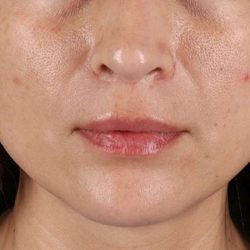 Lip Lift Before & After Patient #6244