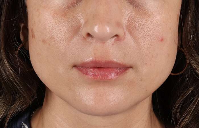 Lip Lift Before & After Patient #6244