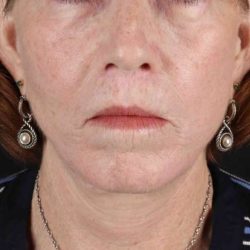 Lip Lift Before & After Patient #6255
