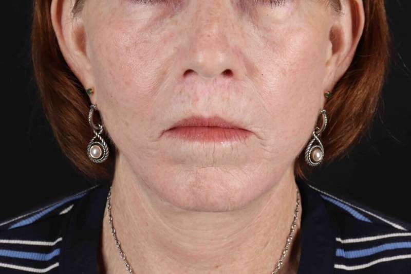 Lip Lift Before & After Patient #6255