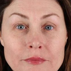 Lip Lift Before & After Patient #6266