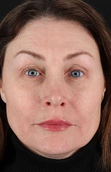 Lip Lift Before & After Patient #6266