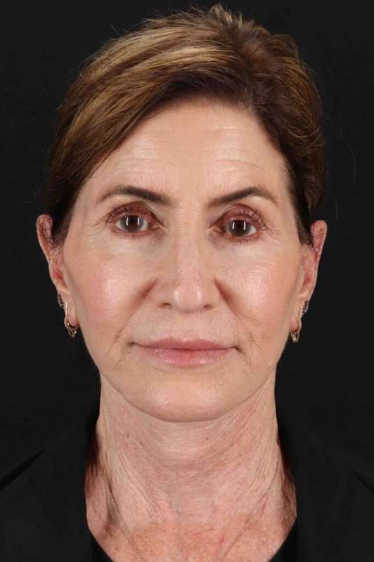 Lip Lift Before & After Patient #6288