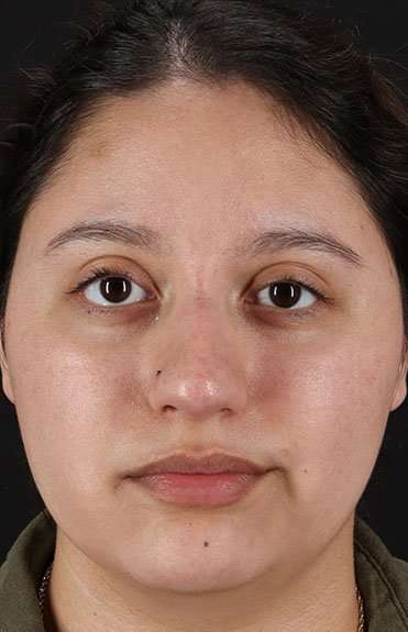 Liquid Rhinoplasty Before & After Patient #6299