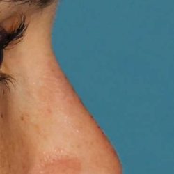 Liquid Rhinoplasty Before & After Patient #6302