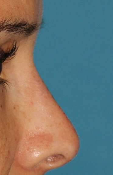Liquid Rhinoplasty Before & After Patient #6302