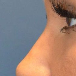 Liquid Rhinoplasty Before & After Patient #6305