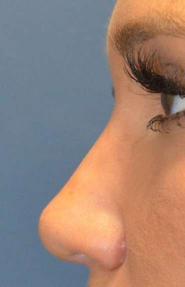 Liquid Rhinoplasty Before & After Patient #6305
