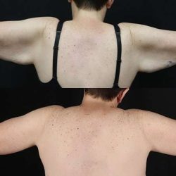 Brachioplasty (Arm Lift) Before & After Patient #1169