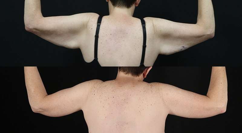 Brachioplasty (Arm Lift) Before & After Patient #1169
