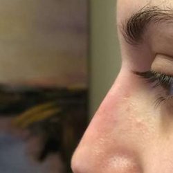 Liquid Rhinoplasty Before & After Patient #6308
