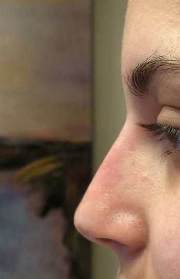 Liquid Rhinoplasty Before & After Patient #6308