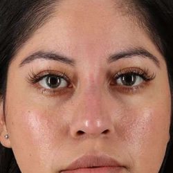 Liquid Rhinoplasty Before & After Patient #6319