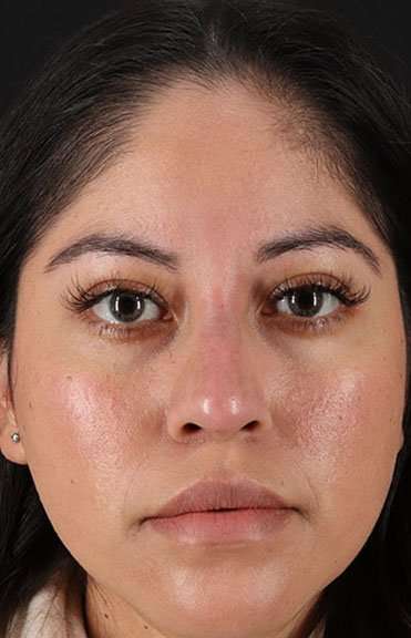 Liquid Rhinoplasty Before & After Patient #6319
