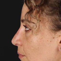 Liquid Rhinoplasty Before & After Patient #6322