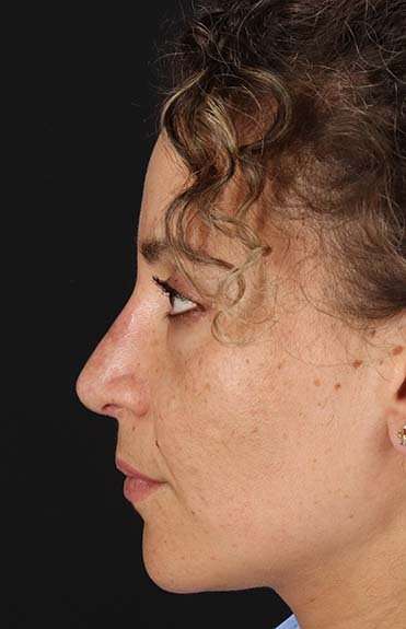 Liquid Rhinoplasty Before & After Patient #6322