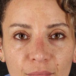 Liquid Rhinoplasty Before & After Patient #6333