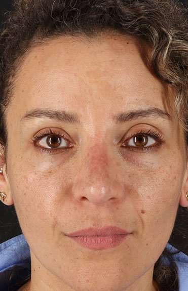 Liquid Rhinoplasty Before & After Patient #6333