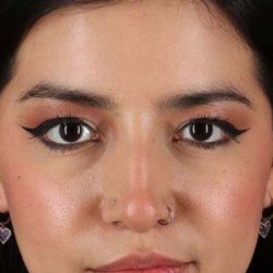 Liquid Rhinoplasty Before & After Patient #6344