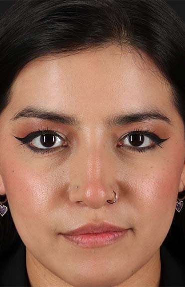Liquid Rhinoplasty Before & After Patient #6344