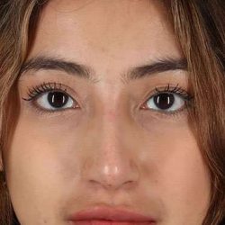Liquid Rhinoplasty Before & After Patient #6355
