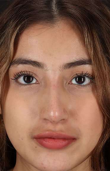 Liquid Rhinoplasty Before & After Patient #6355