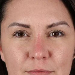 Liquid Rhinoplasty Before & After Patient #6366