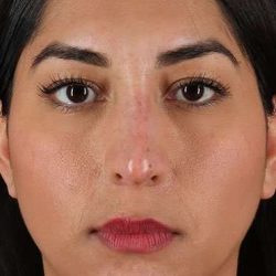 Liquid Rhinoplasty Before & After Patient #6377