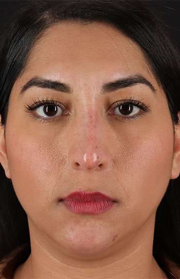 Liquid Rhinoplasty Before & After Patient #6377